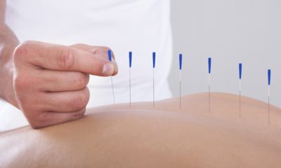 Dry Needling